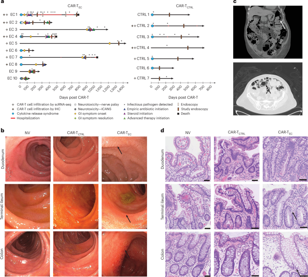 Una complicanza intestinale delle CAR-T rivela cellule immunitarie persistenti nei tessuti
