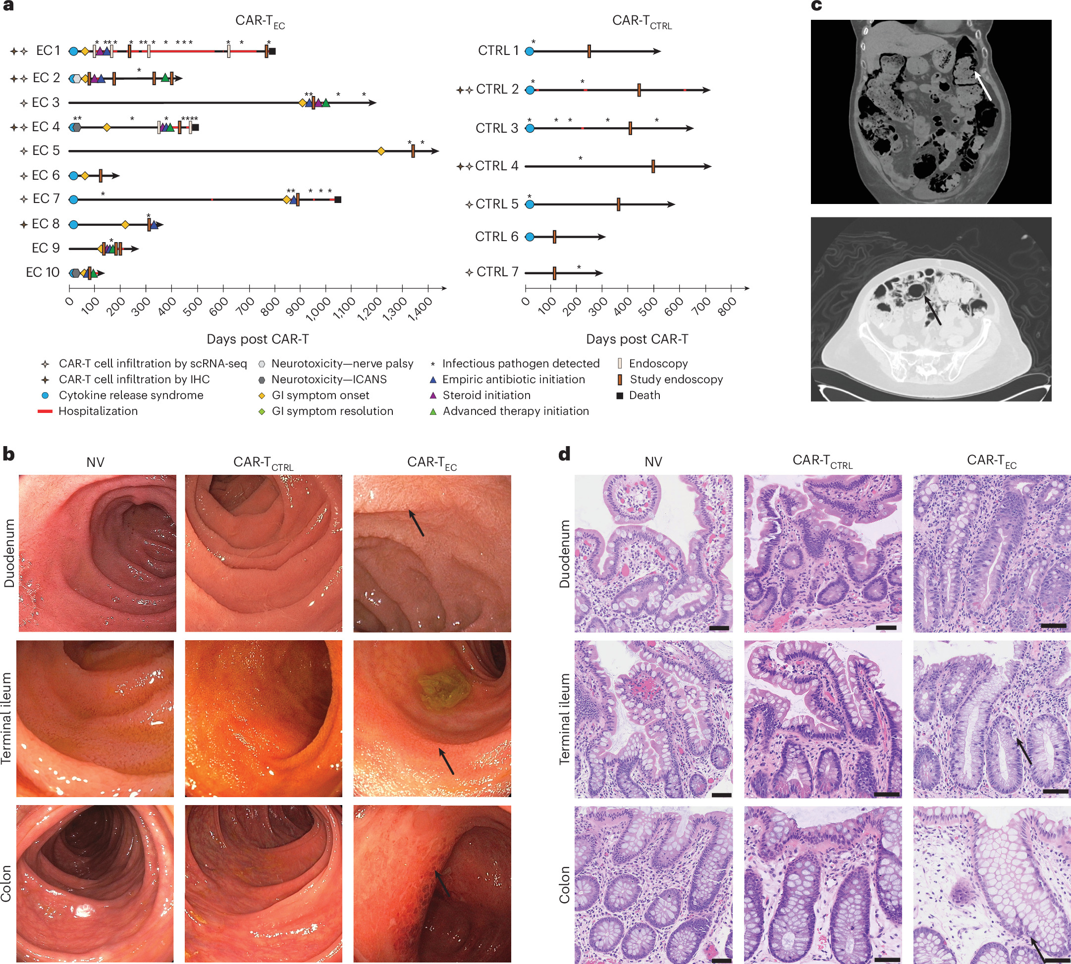 Una complicanza intestinale delle CAR-T rivela cellule immunitarie persistenti nei tessuti
